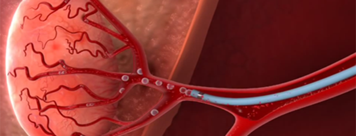 a EMBOLIZAÇÃO DE MIOMAS