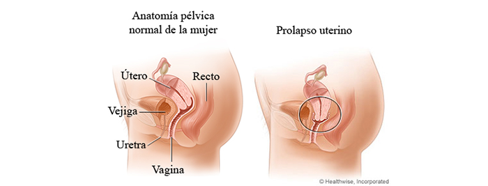 pro prolapso