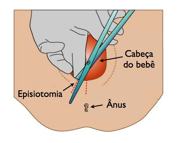 Episiotomia